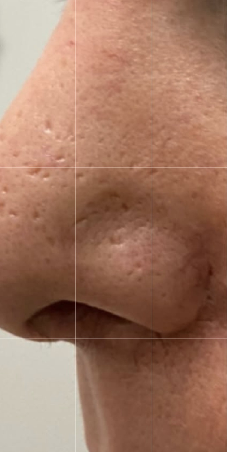 صورة قبل العلاج في مركز بالديرما