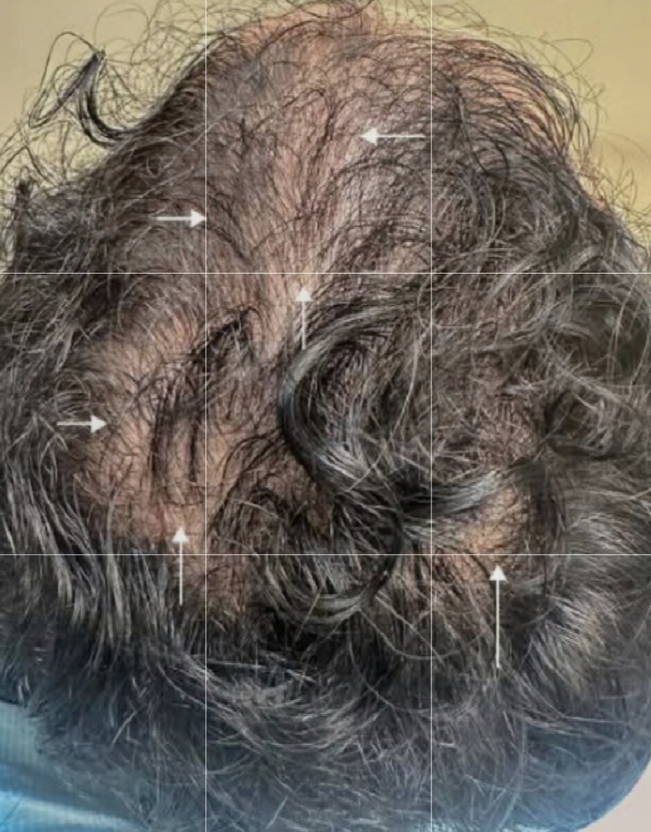 صورة قبل العلاج في مركز بالديرما