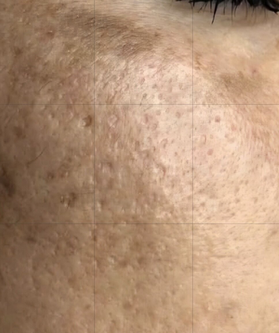 صورة قبل العلاج في مركز بالديرما