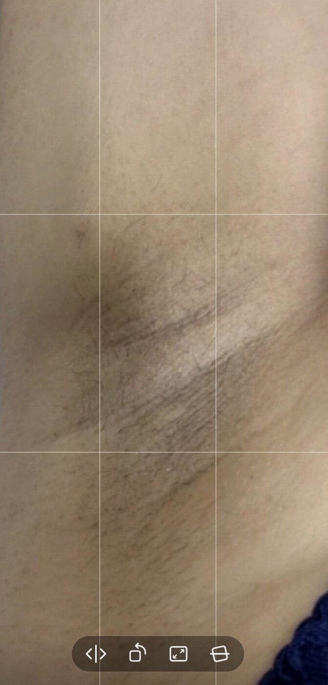 صورة قبل العلاج في مركز بالديرما