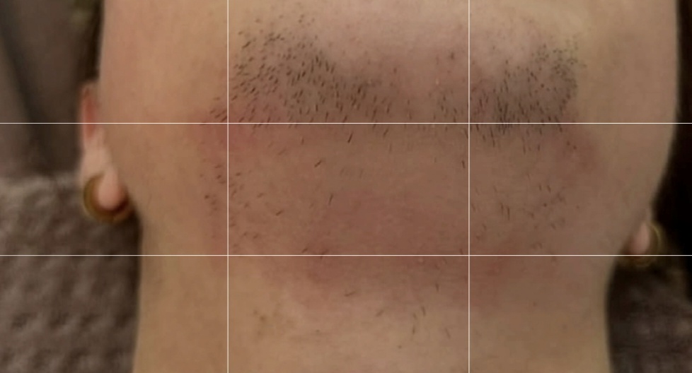 صورة قبل العلاج في مركز بالديرما